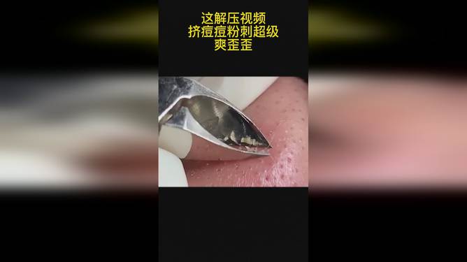 最新擠膿包視頻，見(jiàn)證變化的力量，自信與成就感的誕生之地