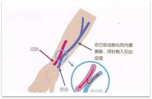 靜脈瘺最新資訊，掌握最前沿的健康信息